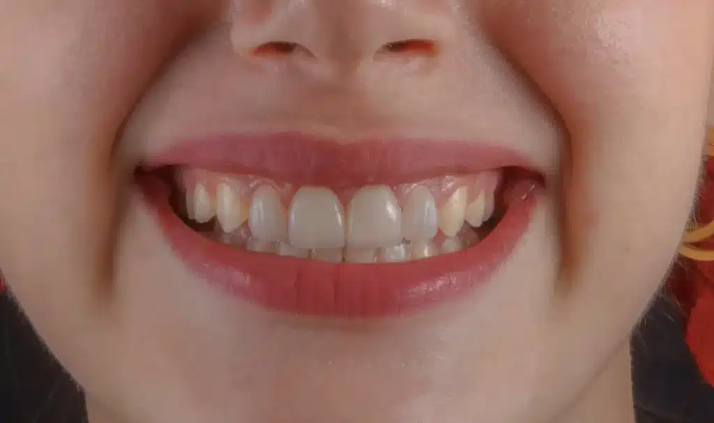 Dreaming About Your Teeth Falling Out elonmurskkkk